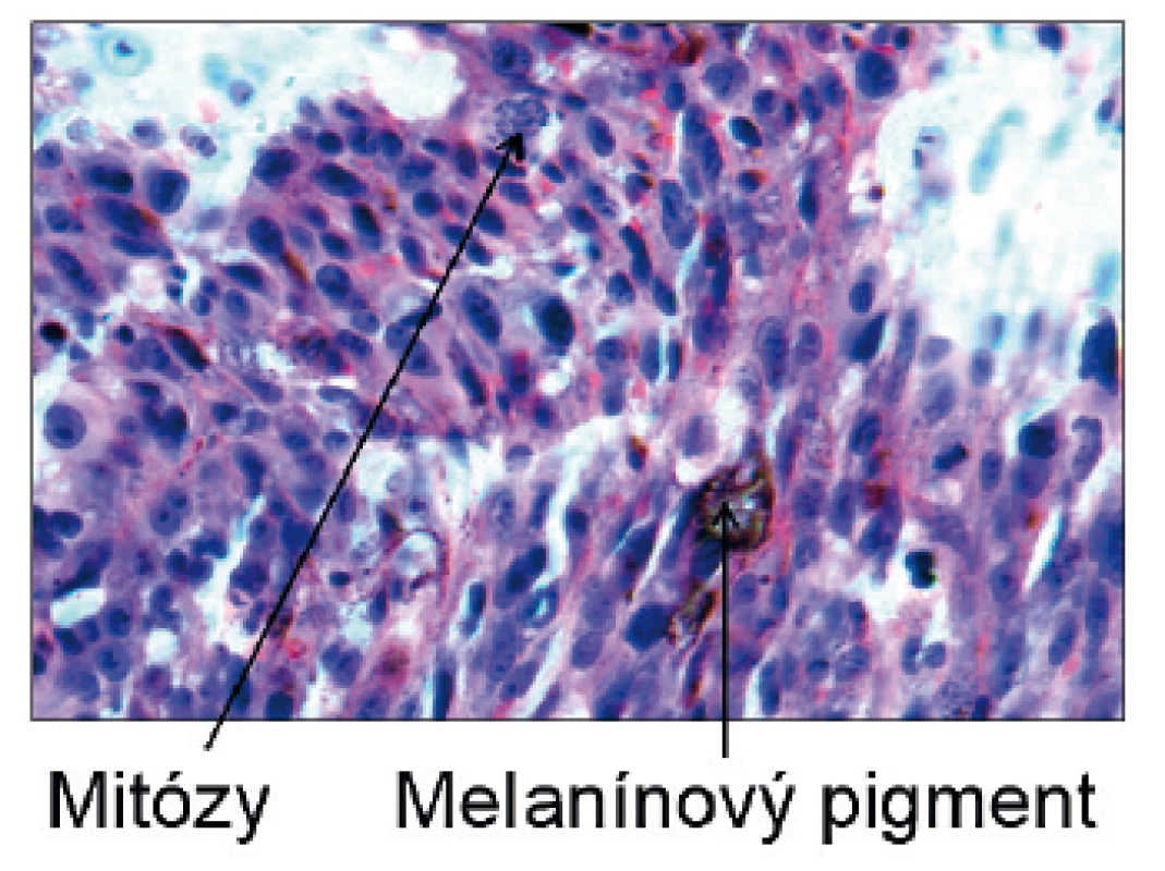 Detail s viditeľným melanínovým pigmentom a mitotickou aktivitou.