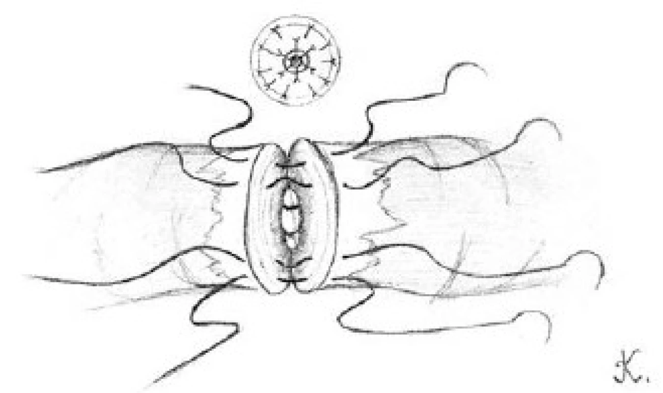 Přiblížení přední svalové vrstvy obou konců chámovodu pomocí čtyři dvojitých 9-0 nylonových stehů
Fig. 3. The approximation of the anterior muscle layers for both ends of vas deferens is approximated with four double armed 9-0 nylon sutures