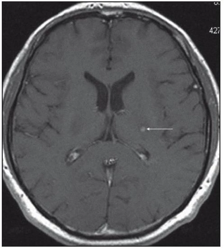 MR mozku v roce 2008: zobrazení zadního raménka kapsuly interny vlevo. Všechna ložiska mají stejné chování, nativně jsou patrná v sekvenci FLAIR, T2, PD jako necharakteristická hypersignální, postkontrastně dochází k sycení jejich centra. Transverzální řez.