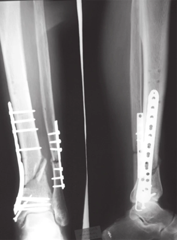 Osteosyntéza zlomeniny distálnej tíbie vľavo po zložení vonkajšieho fixátora uhlovo stabilnou dlahou
Fig. 8: Fixation of left tibial fracture with internal fixator