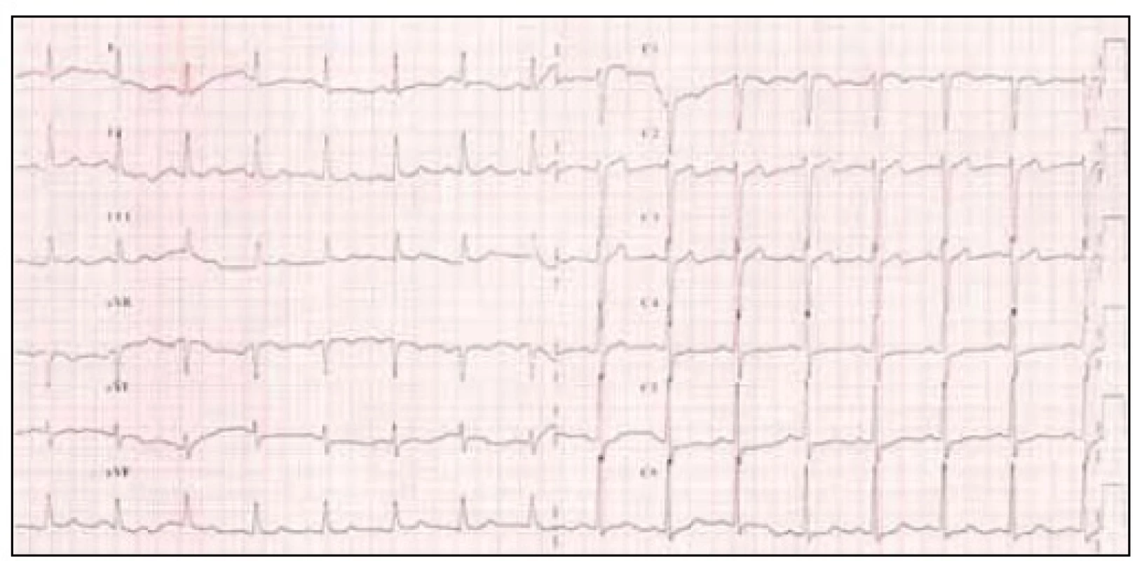 12svodové EKG před hyperventilačním testem.