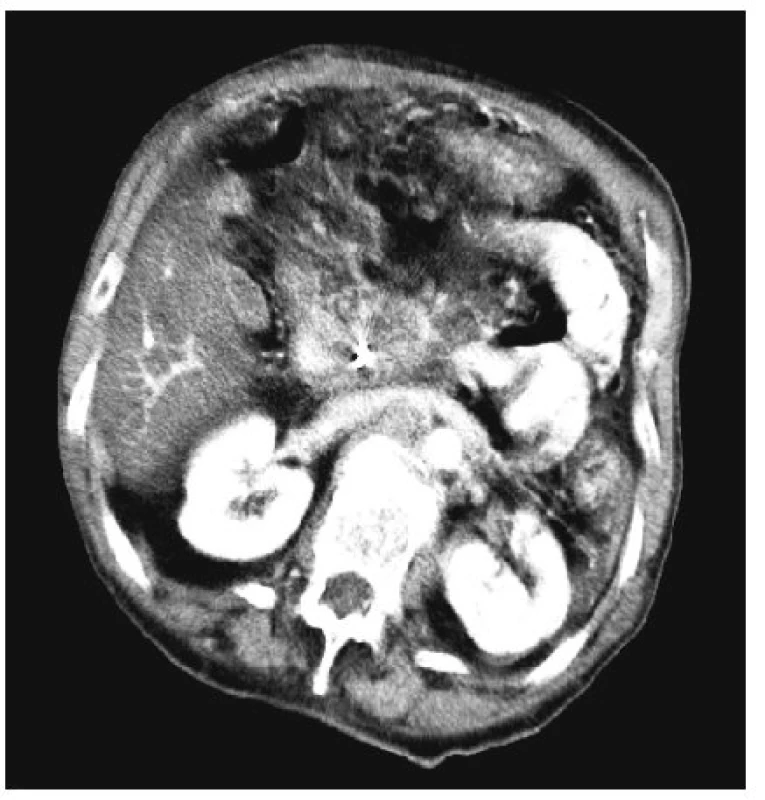 Tentýž tumor těla pankreatu 3 měsíce po RFA
Fig. 5. The same tumor of the pancreatic head 3 months after the RFA procedure
