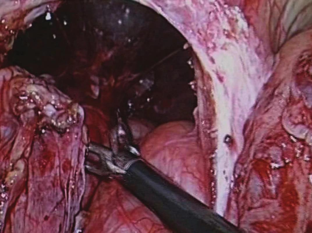 Resekce kýlního vaku – herniotomie
Fig. 15: Resection of the hernial sac – herniotomy