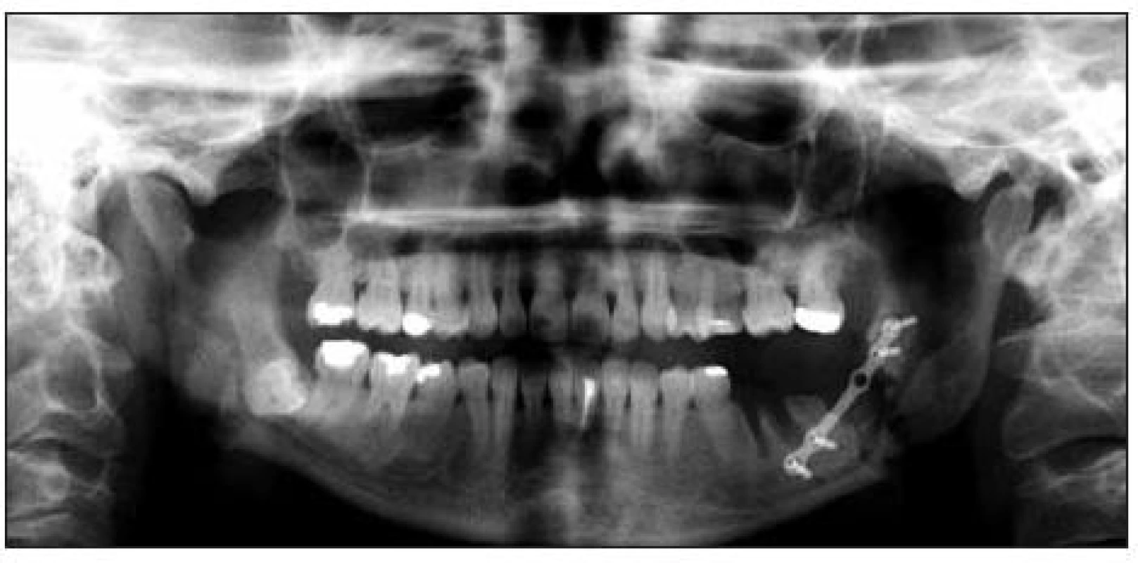 Ortopantomogram – stav po vybavení zubů 36 a 38, repozici a osteosyntéze iatrogenní zlomeniny těla dolní čelisti