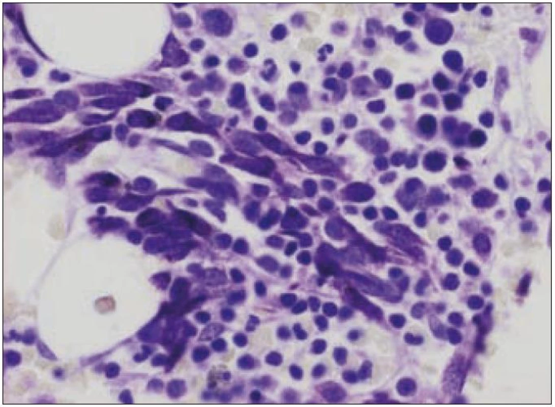 Atypické mastocyty v kostní dřeni. Barveno kresylovou violetí ke znázornění charakteristických granulí v cytoplazmě patologických mastocytů. Zvětšení 400krát. Snímek MUDr. Leoš Křen, Ph.D.
