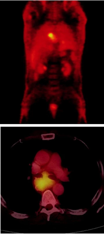 a) PET vyšetření – koronární obraz
Vysoká akumulace FDG v oblasti mediastina a drobné ložisko
vysoké akumulace FDG lokalizované do levého plicního křídla
představuje primární SCLC.
b) Hybridní PET/CT vyšetření u téhož pacienta –
axiální obrazy
Objemná masa se zřetelně zvýšenou akumulací FDG odpovídá
zvětšeným LU v mediastinu.
