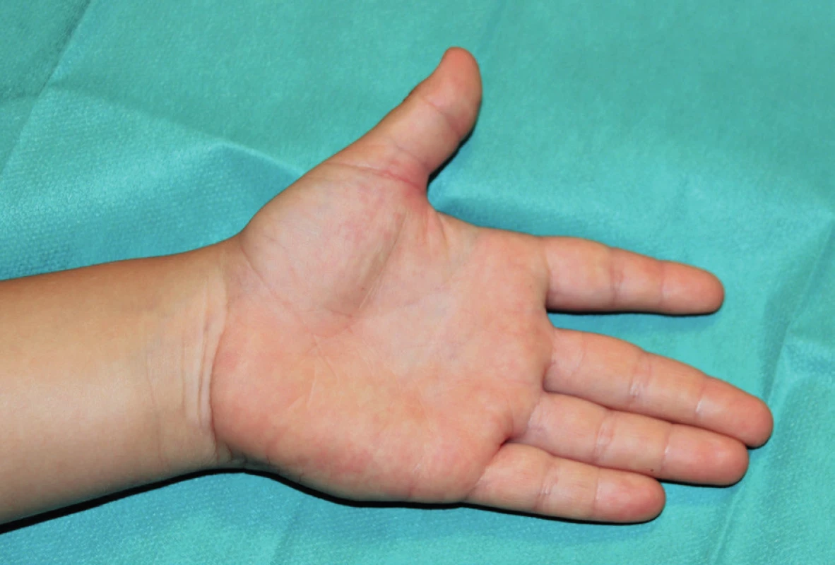 Kontrolní klinické vyšetření – dítě schopno plné aktivní extenze palce