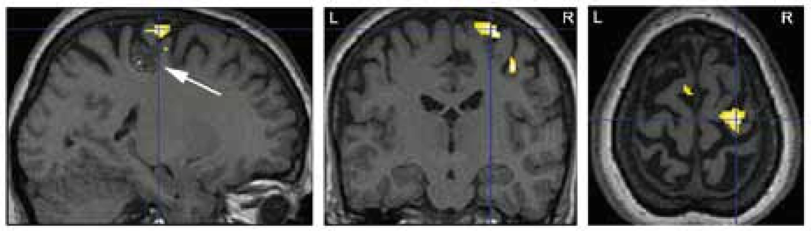 Výsledek fMR vyšetření k objasnění anatomického vztahu mezi primárním motorickým kortexem pro levou ruku (žlutá barva; p &lt; 0,05 FWE corr.) a strukturální lézí (kavernomem) na dně sulcus centralis vpravo – označena šipkou (pacient 5).