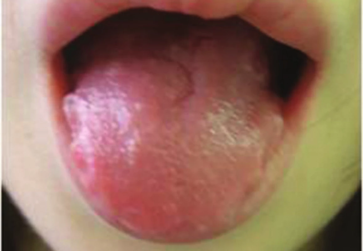 Alergická kontaktní cheilitida granulomatózního typu po solích rtuti v amalgámu