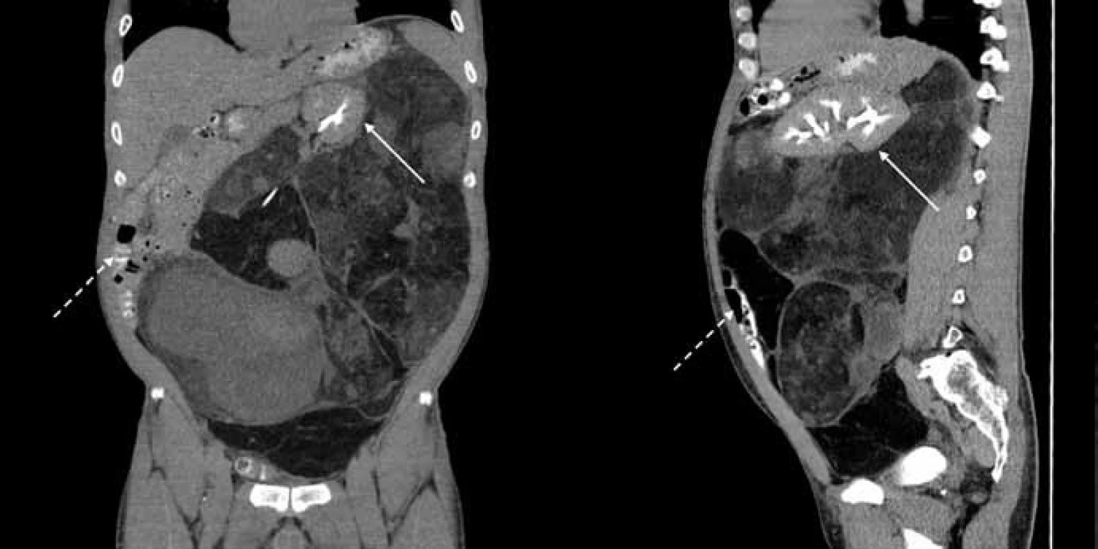Snímky z CT vyšetření břicha (vlevo – koronární řez, vpravo – sagitální řez).