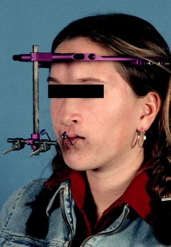 The Rigid External Distactor (RED) system in situ on a patient with a bilateral cleft-lip-alveolus and palate for advancing the hypoplastic maxilla