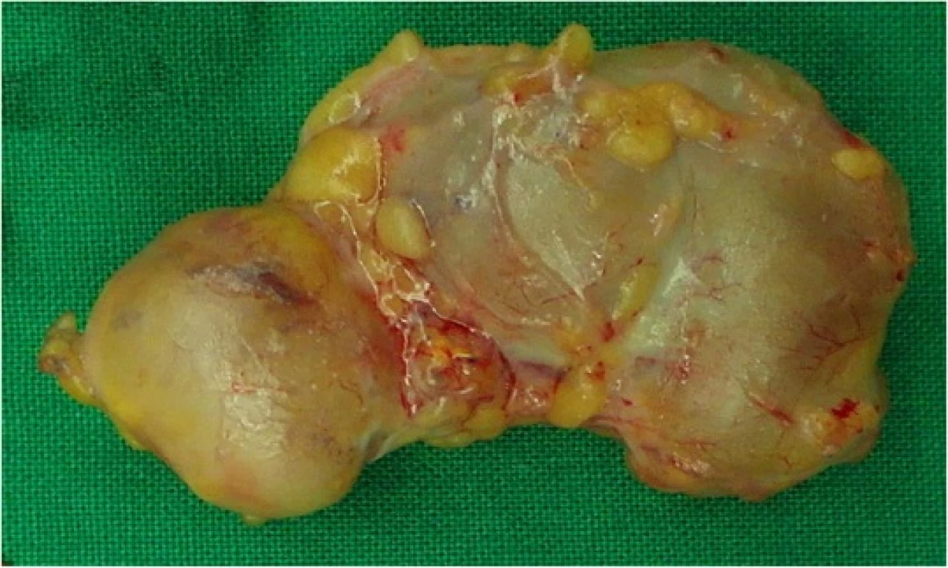 Excised surgical specimen of the abscess