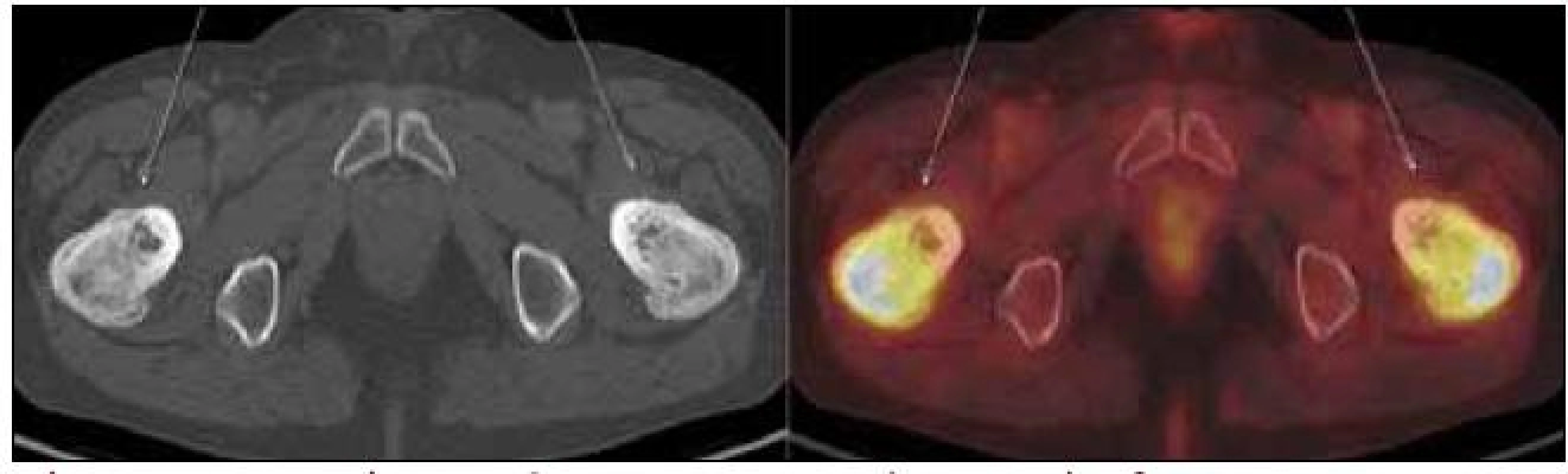 PET-CT zobrazení femuru, transversální řez. Oba femury mají nepravidelnou, převážně sklerotickou strukturu spongiózy s osteolytickými okrsky, v těchto místech je i jasný hypermetabolizmus glukózy.