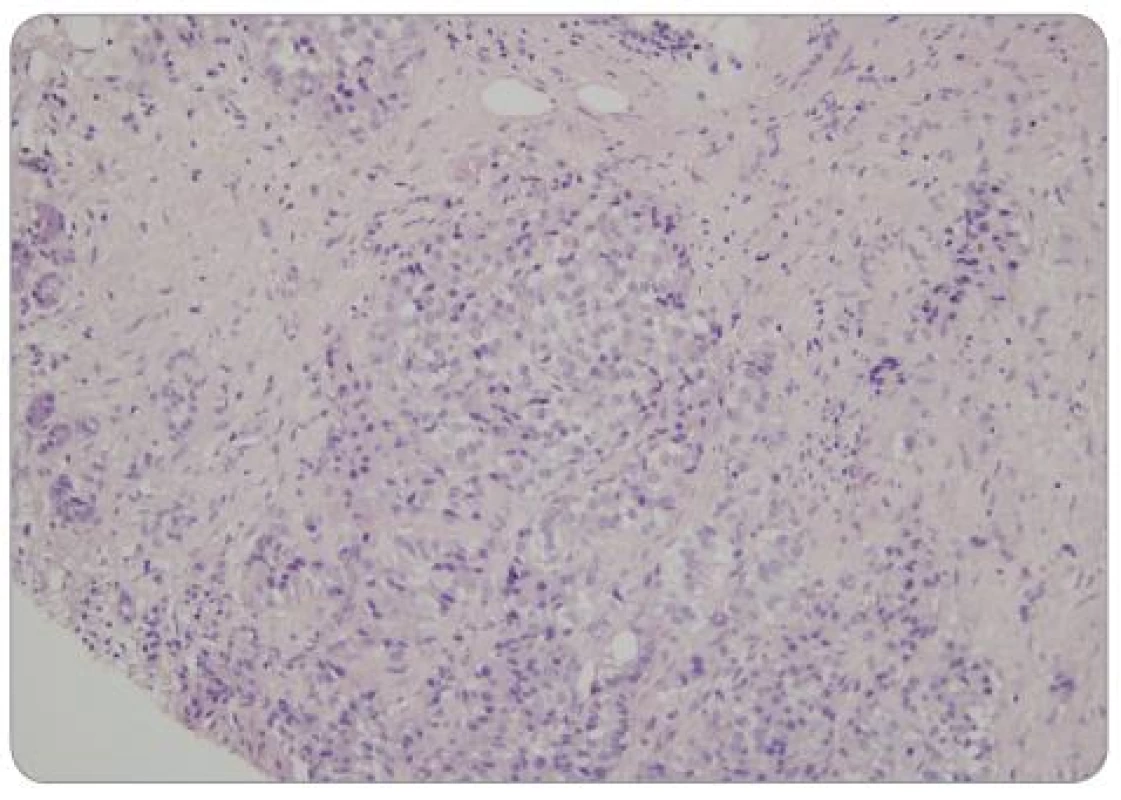 Neuroendokrinní nádor pankreatu – FNAB (hematoxylin eosin).