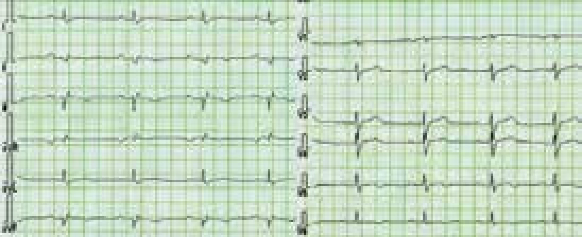EKG nemocného s arytmogenní kardiomyopatií levé komory
