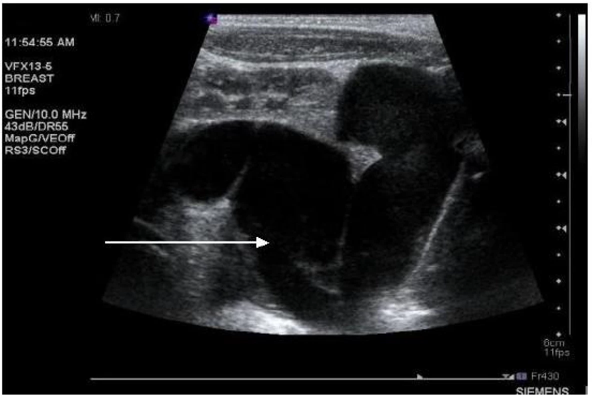 Ultrasonografie, pacient č. 14; šipka ukazuje na výrazně dilatovaný levostranný močovod.

Fig. 4. Ultrasound, patient No 14; gross dilation of the left ureter (arrow).