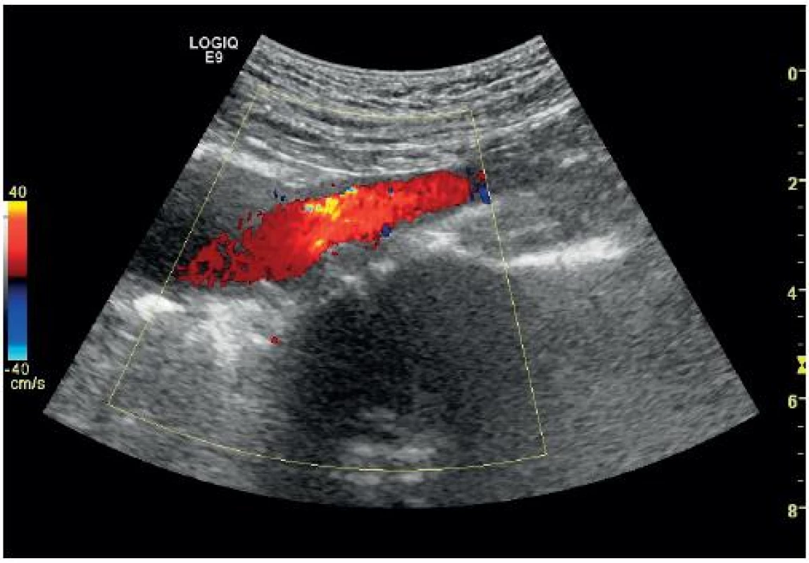 Aneurysma břišní aorty s přechodem na společné ilické tepny (barevný Doppler)