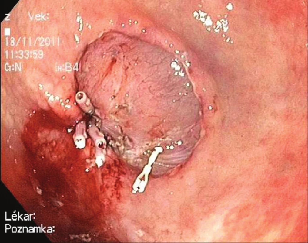 Endoskopická submukózní disekce: Krvácení ze spodiny ošetřeno klipy