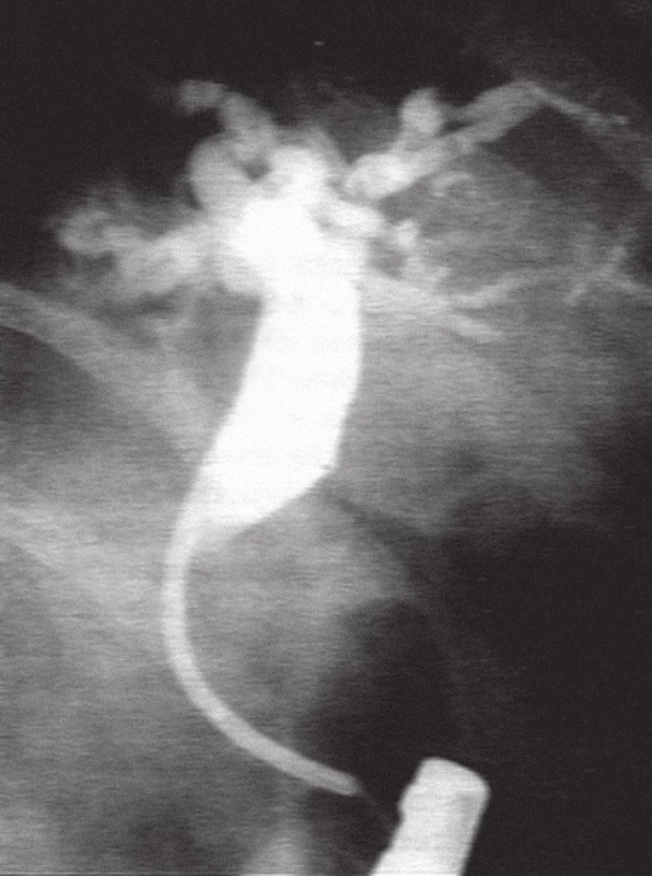 ERC u pacienta z obr. 4, kdy maligní stenóza choledochu byla překlenuta transpapilárně zavedeným plastovým 10 Fr. duodenobiliárním stentem.