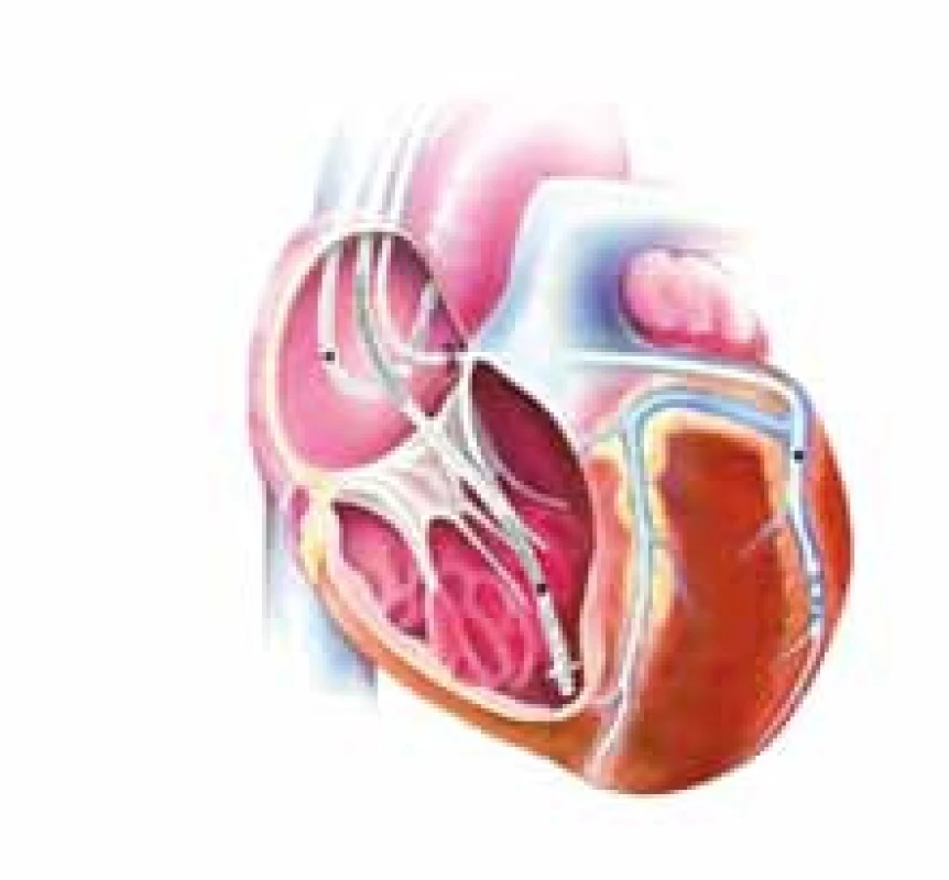 CRT systém se síňovou elektrodou, defibrilační a stimulační elektrodou v pravé komoře a stimulační elektrodou v laterální větvi koronárního sinu pro stimulaci levé srdeční komory.