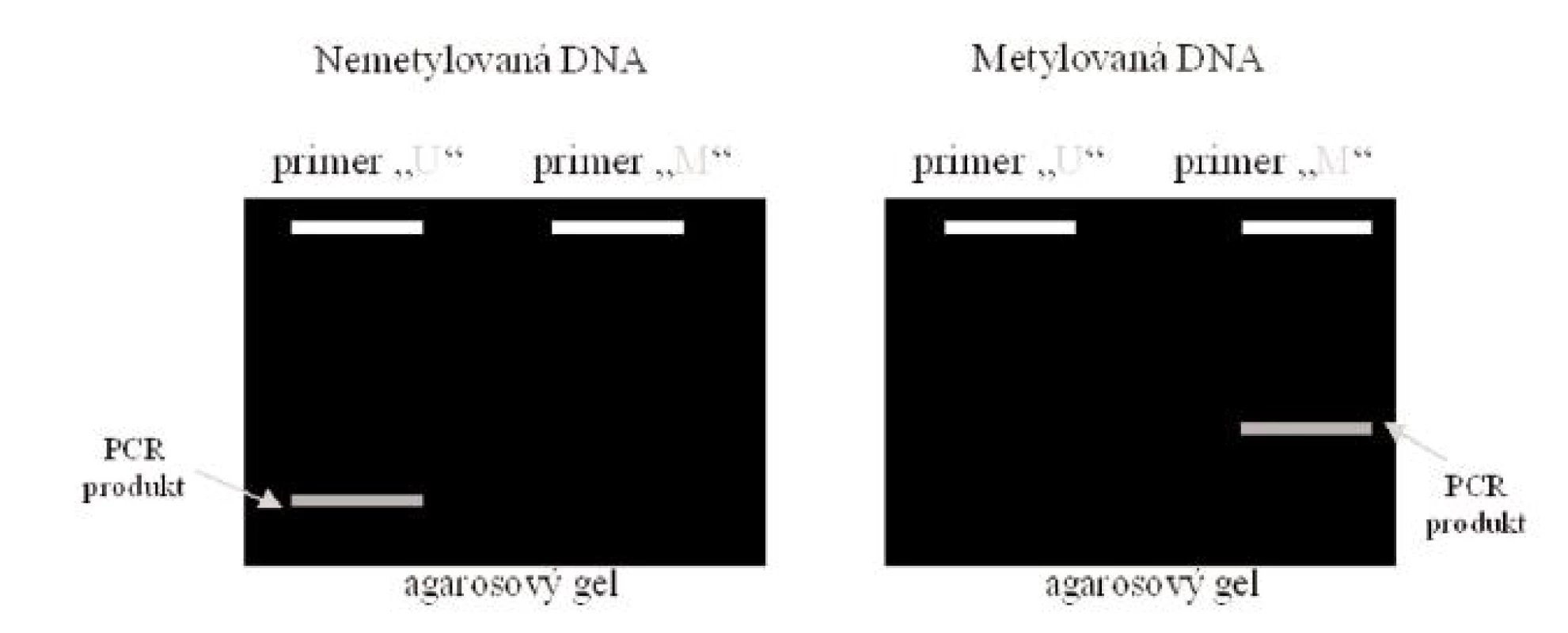 Elektroforetické vyhodnocení MSP
Legenda: Je-li DNA nemetylovaná, vzniká PCR produkt po reakci se setem primerů U, který je specifický pro nemetylovanou DNA. Je-li DNA metylovaná, vzniká PCR produkt po reakci se setem primerů M, který je specifický pro metylovanou DNA.