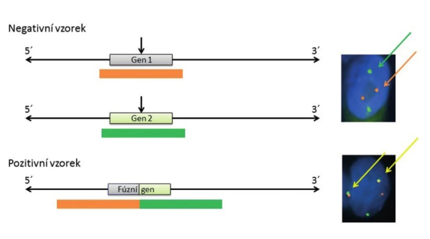 Schematické zobrazení fúzní FISH sondy, principu detekce translokace mezi dvěma geny (Gen1 a Gen 2) a jejich projev v jádře buňky po FISH analýze.