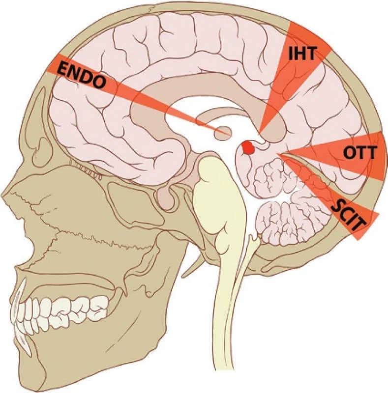 Sagitální řez mozkem a schematicky naznačené směry jednotlivých chirurgických přístupů
Supracerebelární-infratentoriální přístup (SCIT), okcipitální-transtentoriální přístup (OTT), interhemisferický-transkalózní přístup (IHT) a transventrikulární endoskopický přístup (ENDO).
Upraveno dle „Skull and brain sagittal” autorů Patrick J. Lynch a C. Carl Jaffe, použito na základě CC BY 2.5.
Fig. 4: Sagittal section of the brain with schematically depicted surgical approaches
Supracerebellar-infratentorial approach (SCIT), occipital-transtentorial approach (OTT), interhemispheric-transcallosal approach (IHT) and transventricular endoscopic approach (ENDO).
Adapted from &quot;Skull and brain sagittal&quot; by Patrick J. Lynch and C. Carl Jaffe; used under CC BY 2.5.