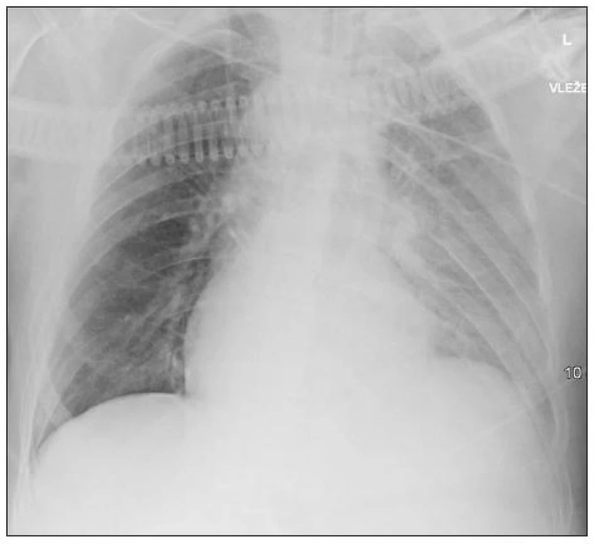 Vstupní RTG hrudníku při přijetí (70 min od úrazu)
Fig. 1. Baseline thoracic x-ray on admission (70 min after the injury)