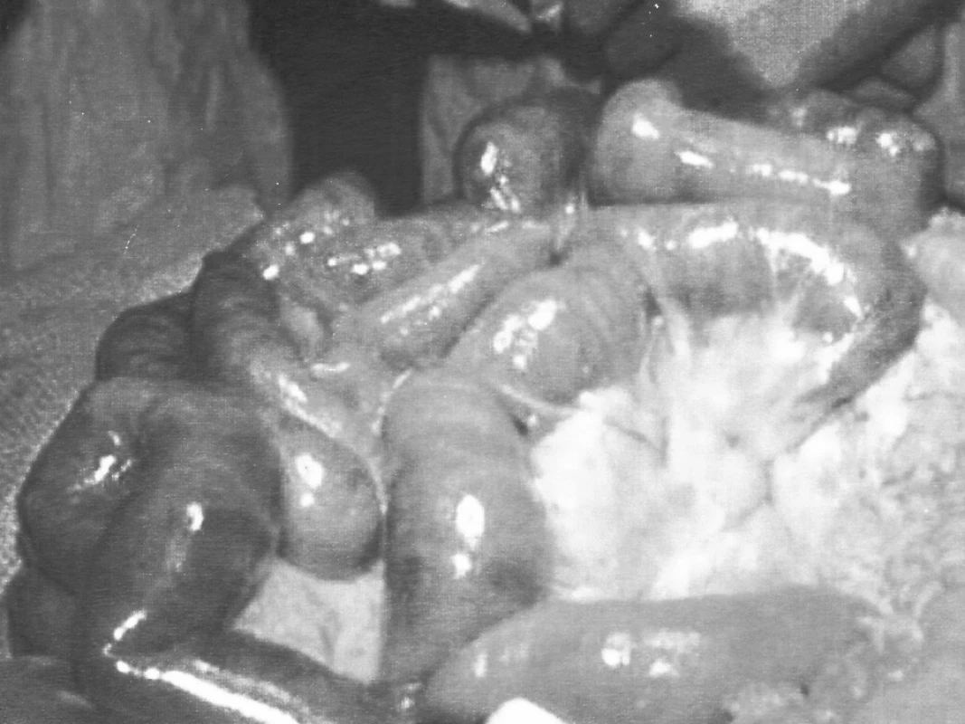 Gangréna tenkého čreva – arteriálny uzáver
Pic. 1. Gangrene of the small intestine – arterial closure