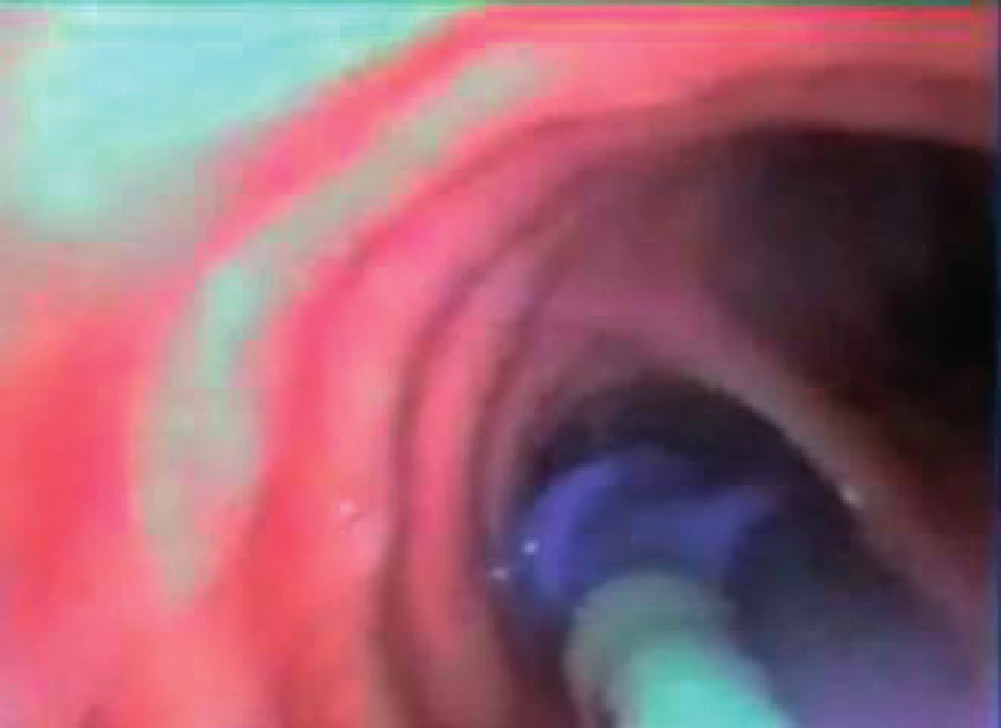 Kamera umístěná pod tracheálním ústím rourky snímá bifurkaci a odstup pravého hlavního bronchu