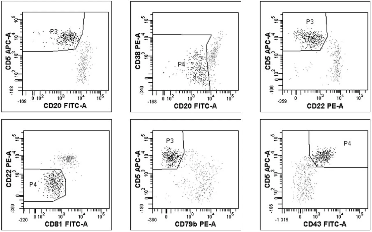 a–f. Výstupy analýzy minimální reziduální nemoci sledované čtyřbarevnou průtokovou cytometrií (18) u pacienta s CLL po léčbě. Zobrazeny pouze grafy identifikující reziduální CLL populaci (černě, šedě normální B-lymfocyty). Gate na B-lymfocyty.