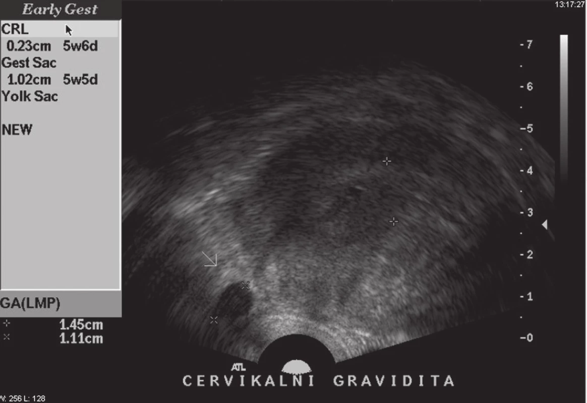 Ultrazvuková verifikace cervikální gravidity.