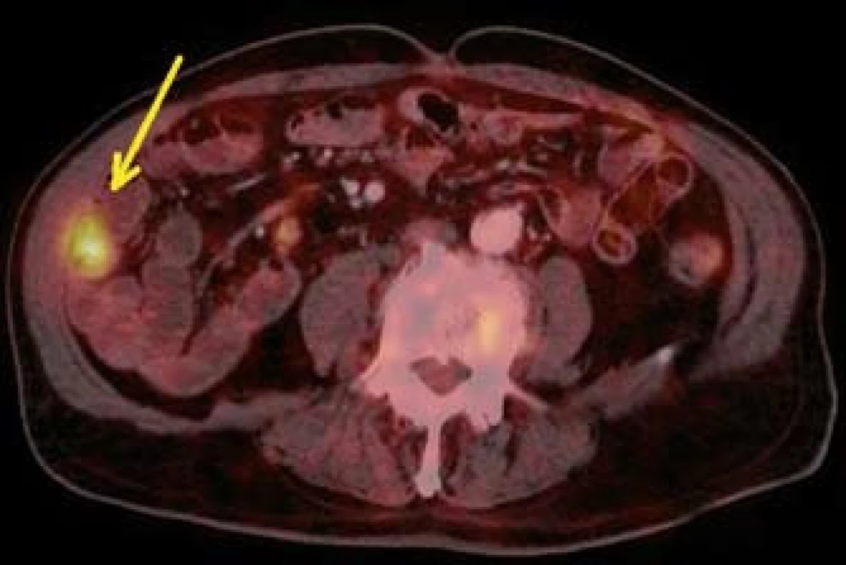 PET CT – metastáza v oblasti kliček tenkého střeva (šipka).
Fig. 9. PET CT – small bowell metastasis (arrow).