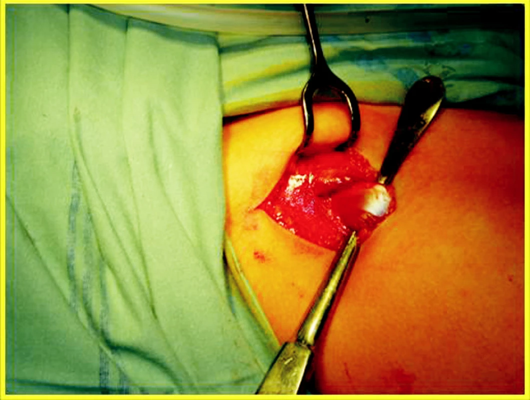 M. rectus femoris - peroperační nález před tenotomií.