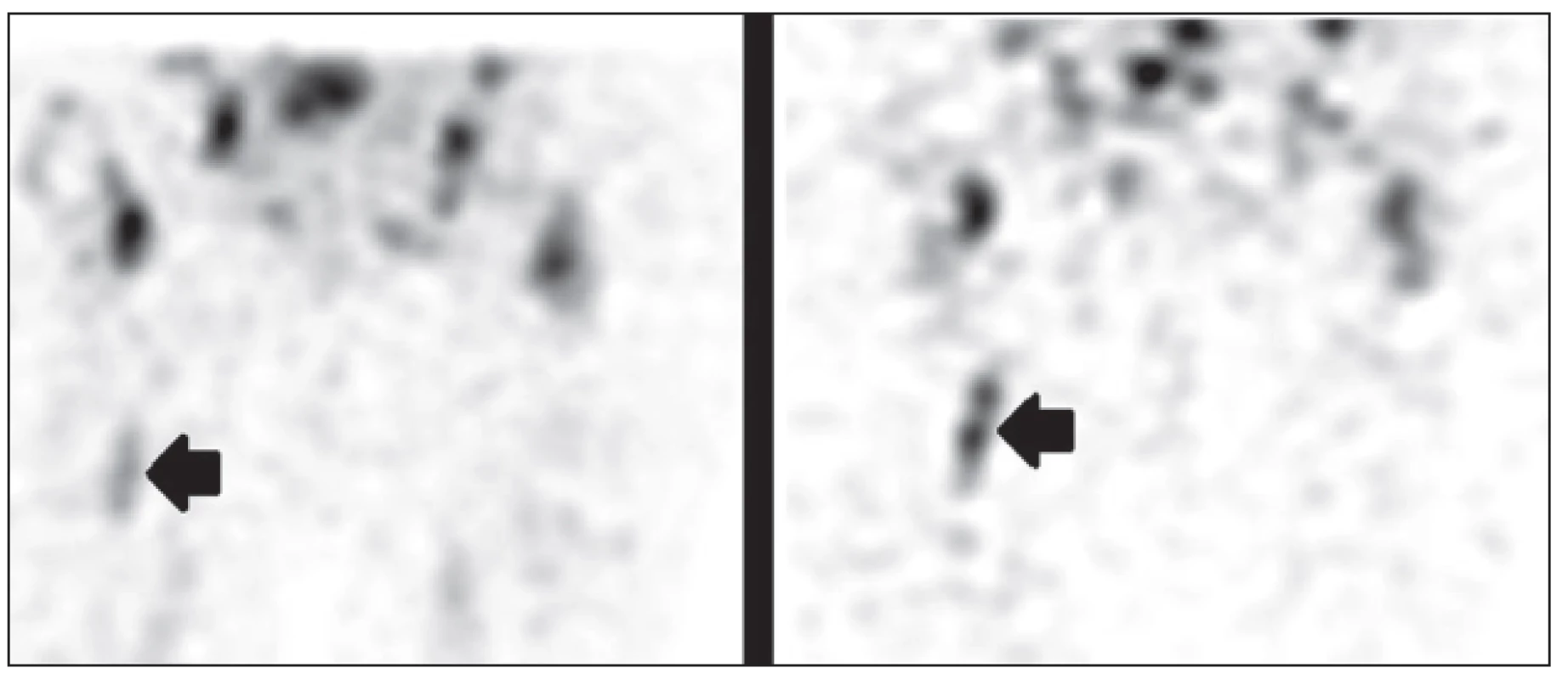 <i>Vyšetření značenými leukocyty, obrazy SPECT časné (vlevo) a pozdní po 24 hod (vpravo).</i>