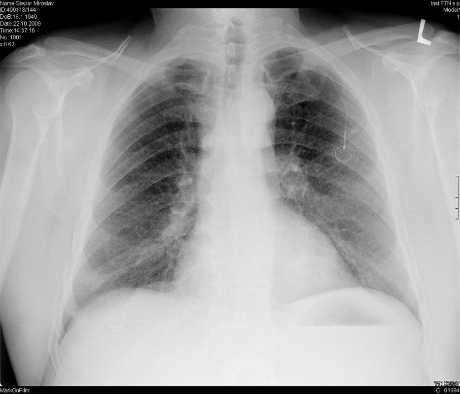 Zadopřední skiagram hrudníku u 60letého muže po resekci ca rektosigmatu a adjuvantní chemoterapii – mikronodulární stíny v obou plicních polích, vlevo stín portu
