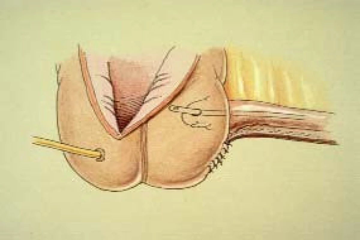 Tyto ilustrace zobrazují proceduru plikace ileocékální chlopně. 
a. Přes zahnutý segment sutury, pomocí níž bylo provedeno zúžení ileálního segmentu, je umístěna 3-0 hedvábná Lembertova sutura (obvykle 5–7 stehů). 
b. Tento nákres ukazuje umístění další plikační sutury. 
c. Tento snímek zachycuje plikační sutury před utažením. Povšimněte si, že stehy blíže ke stěně céka jsou širší než stehy na eferentní větvi. 
d. Po utažení plikačních stehů svírá eferentní větev se stěnou céka přibližně úhel 90 °. V tomto momentě je třeba vyzkoušet plikaci chlopně zavedením 18 F katétru eferentní větví. Při zavádění katétru ileocékální chlopní bychom měli pociťžovat mírný odpor. Pro dosažení tohoto odporu může být nutné umístění další sutury, nebo naopak její odstranění. Přítomnost odporu při zavádění 18 F katétru během operace obvyklesouvisí s dosažením dobré kontinence.