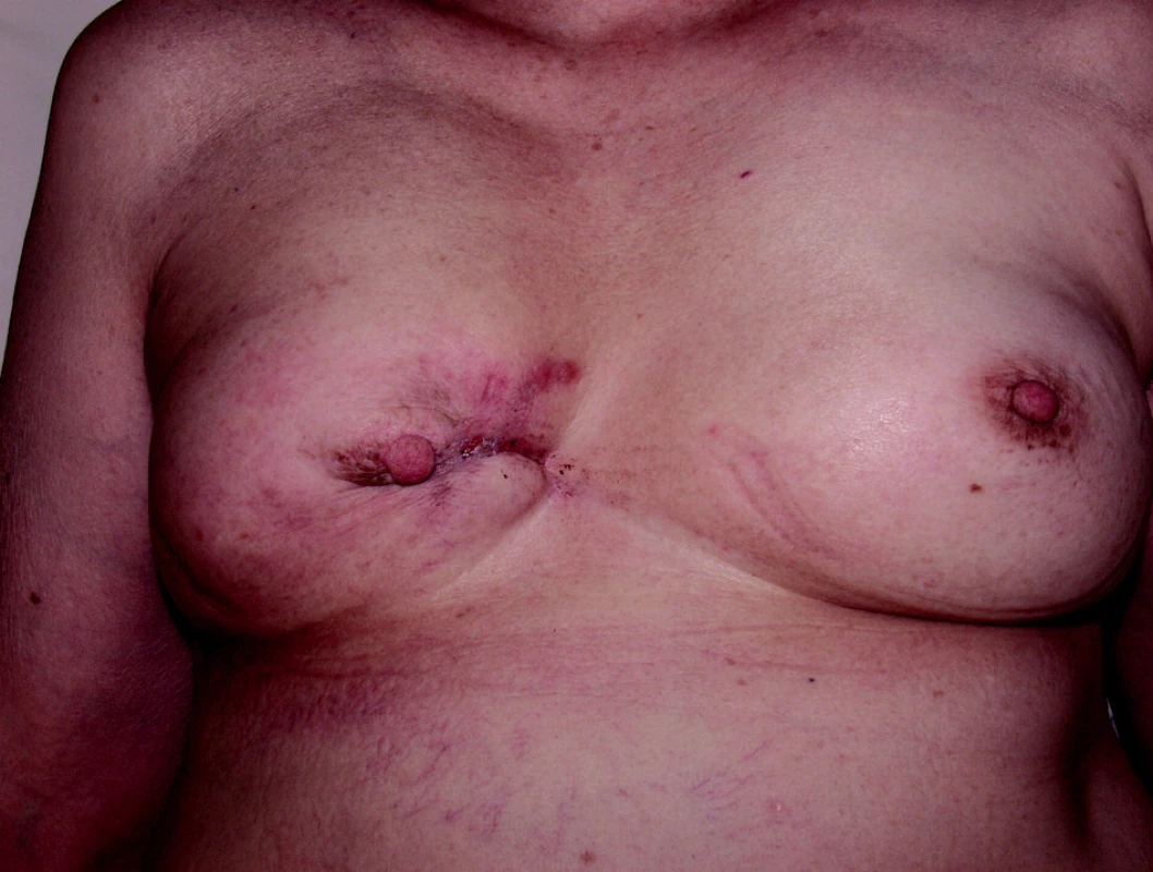 Metastázy karcinomu prsu typu en cuirasse.