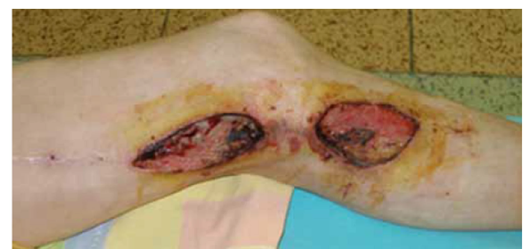Infekcia a dehiscencia operačných rán 1 mesiac po implantácii femoropopliteálneho distálneho bypasu s autológnou reverznou vena saphena magna na ľavej dolnej končatine.