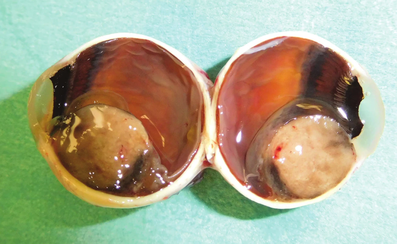 Pacient č. 13 - makrofoto enukleovanej očnej gule po enukleácii pre MM corpus cilliare 
s infiltráciou do irido-korneálneho uhla; histopatologicky sa jedná o zmiešaný typ, ktorý preniká do povrchu bulbu, bez propagácie do n. opticus