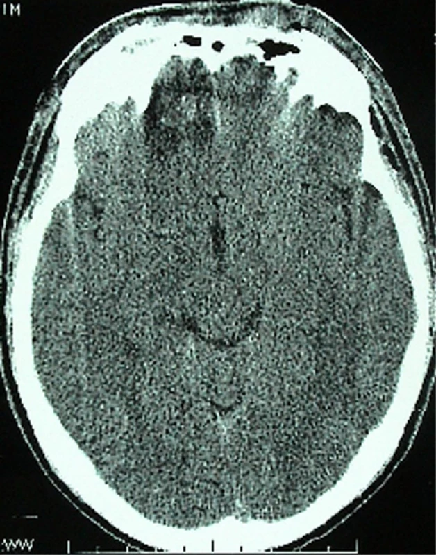 Předoperační CT, s pooperačními změnami na bazi pravého F laloku
