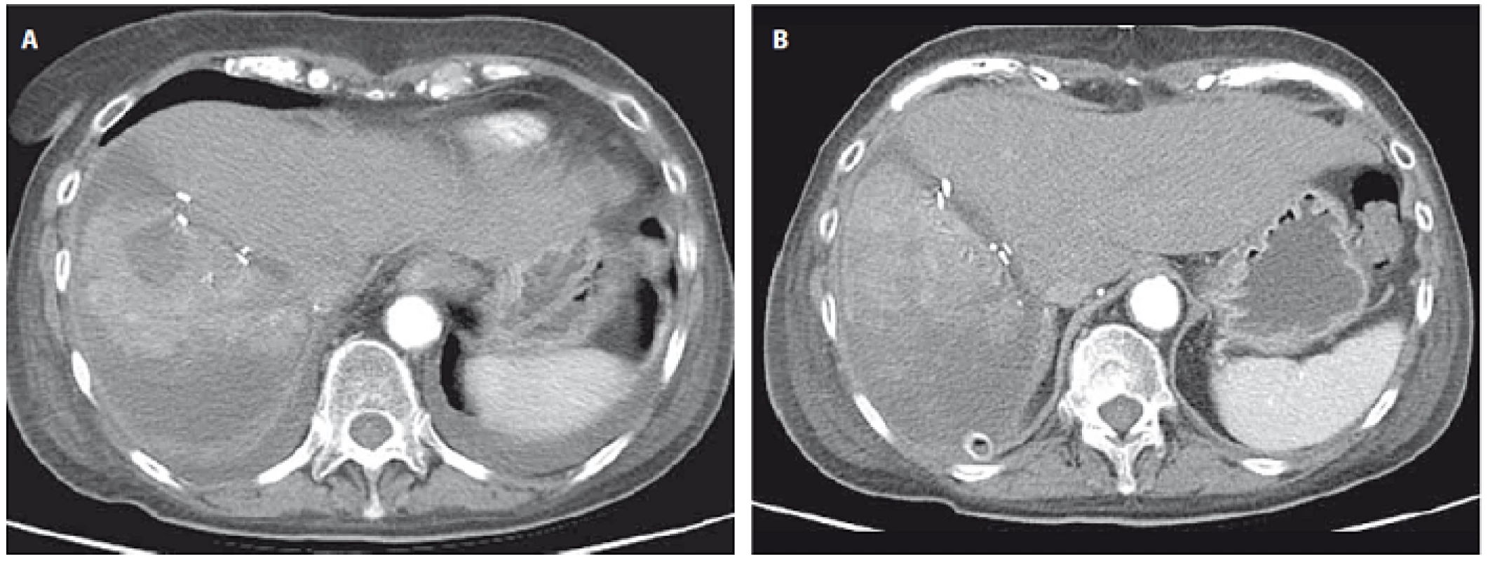 CT image showing the liver four days after ALPPS where further right lobe atrophy and necrosis is seen with no significant contralateral hypertrophy (A) after 14 days where signifi cant left lobe hypertrophy is noticed (B).