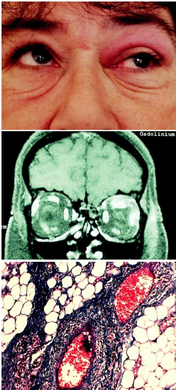 a. Prosáknutí horního víčka vlevo s omezenou elevací bulbu
b. MR: tumor pod stropem pravé očnice s infiltrací horního přímého svalu
c. Histologie: Vaskulitida, parafinový řez, barvení modrý trichrom, zvětšení 125krát
