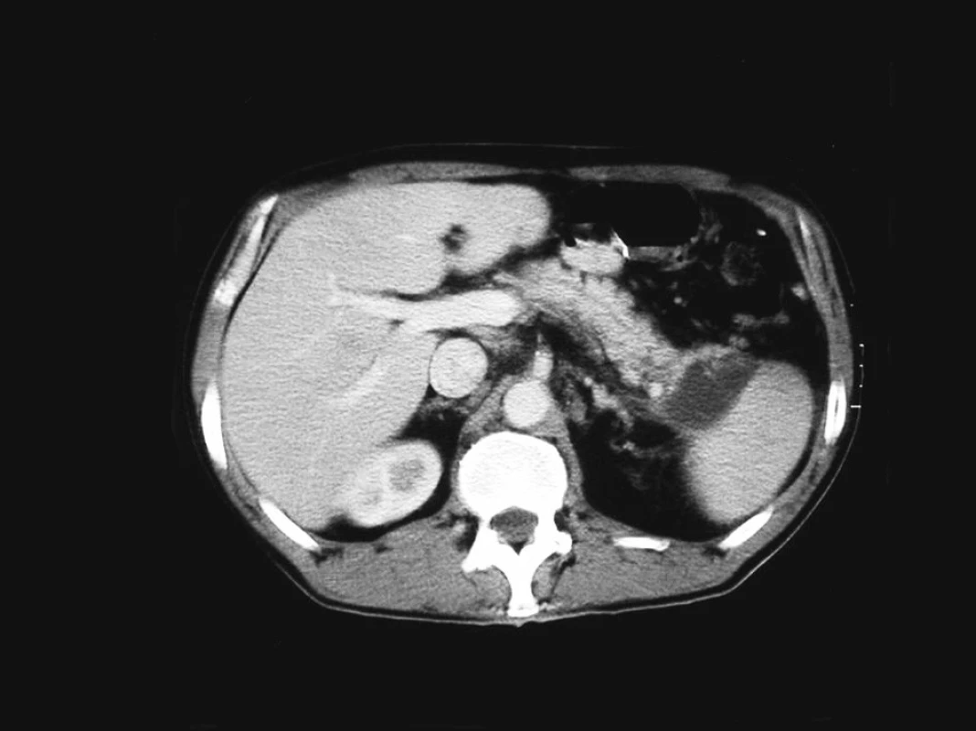 Kontrastní CT sken zobrazující pseudocystu kaudy pankreatu v dubnu 2004
Fig. 1. Contrast CT scan depicting a pseudocyst of the pancreatic cauda, April 2004