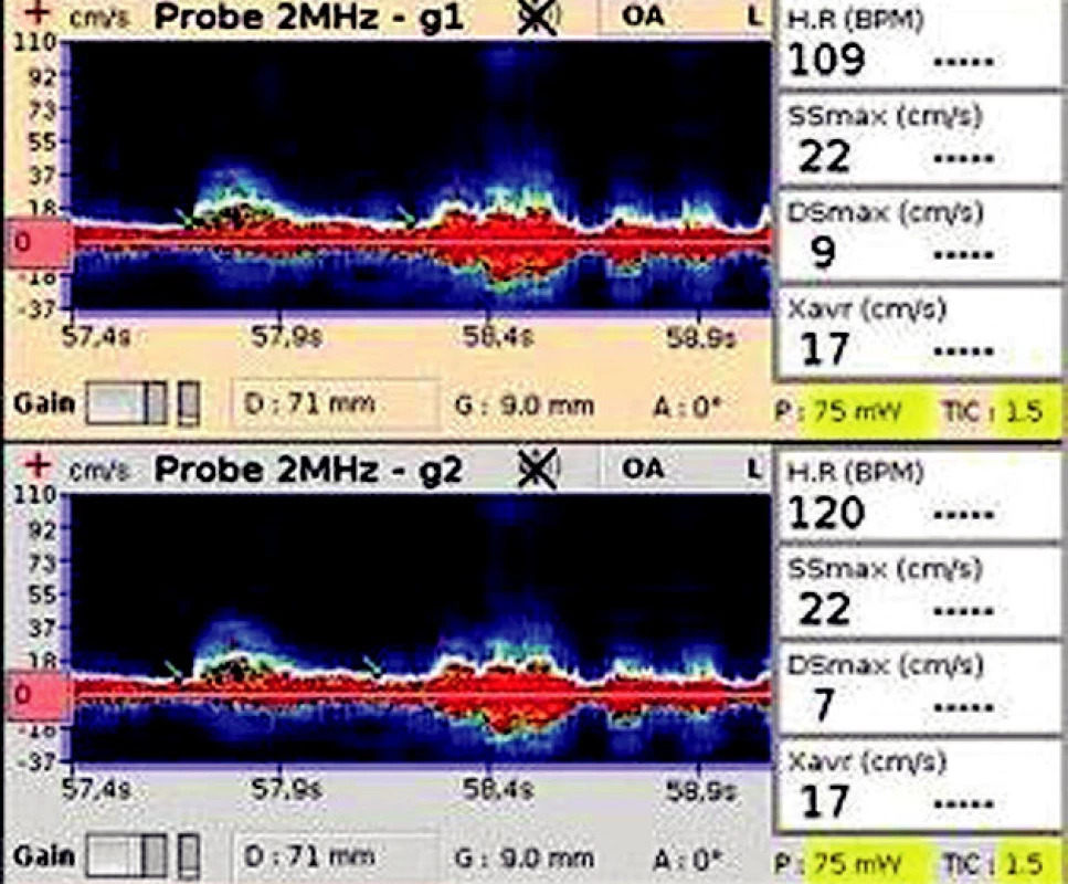 TCD záznam a karotickém siphonu l.dx. Zobrazuje nízkou maximální systolickou a diastolickou rychlost (SSmax a Dsmax), nízkou průměrnou maximální rychlost (Xavr).