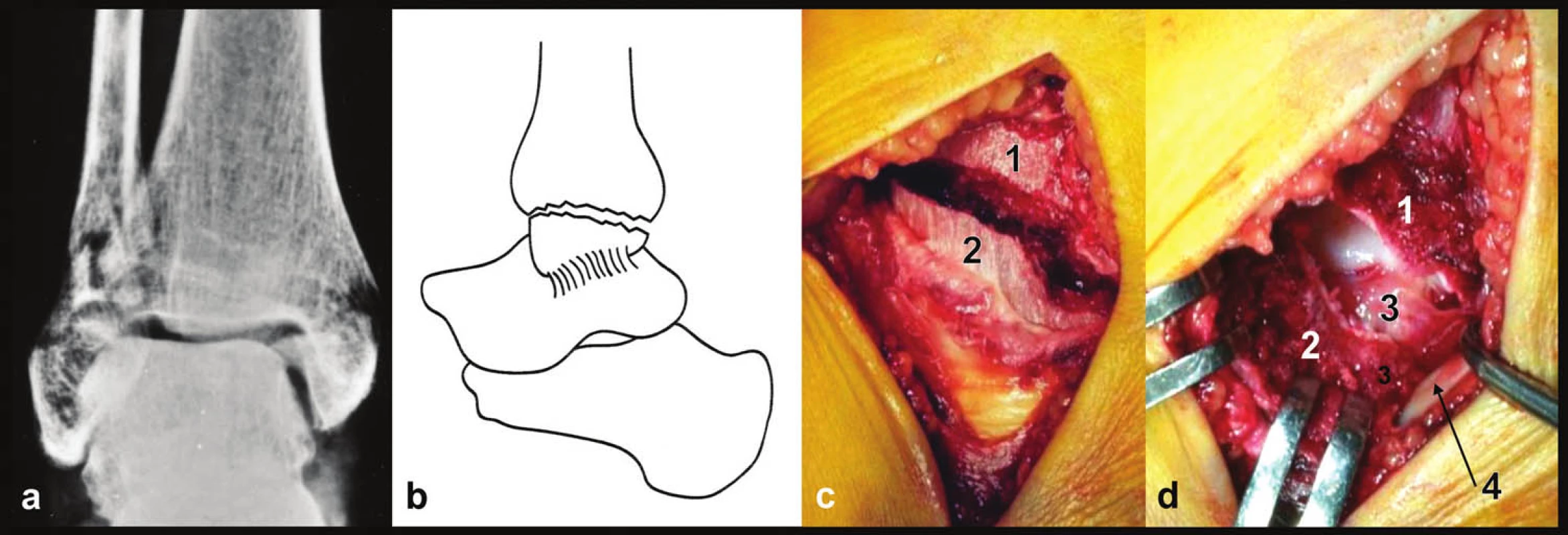 Zlomenina vnitřního kotníku, pravé hlezno a – rtg snímek, b – schéma, c – peroperační foto, d – peroperační foto, stav po odklopení vnitřního kotníku distálně, 1 – distální tibie, 2 – mediální kotník, 3 – hluboká tibiotalární vlákna deltového vazu, 4 – šlacha m. tibialis post.