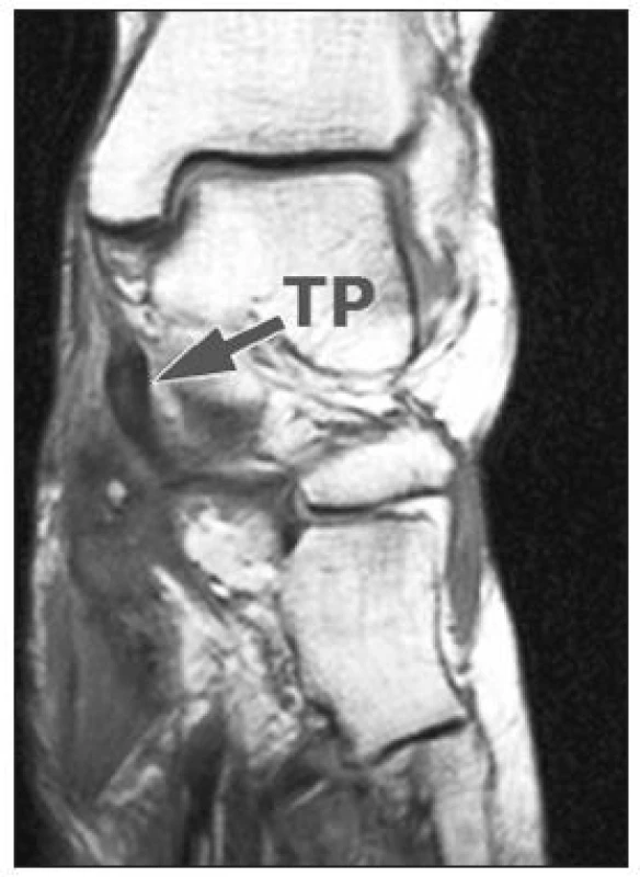 Magnetická rezonance – TP – prasklá šlacha m. tibialis posterior.