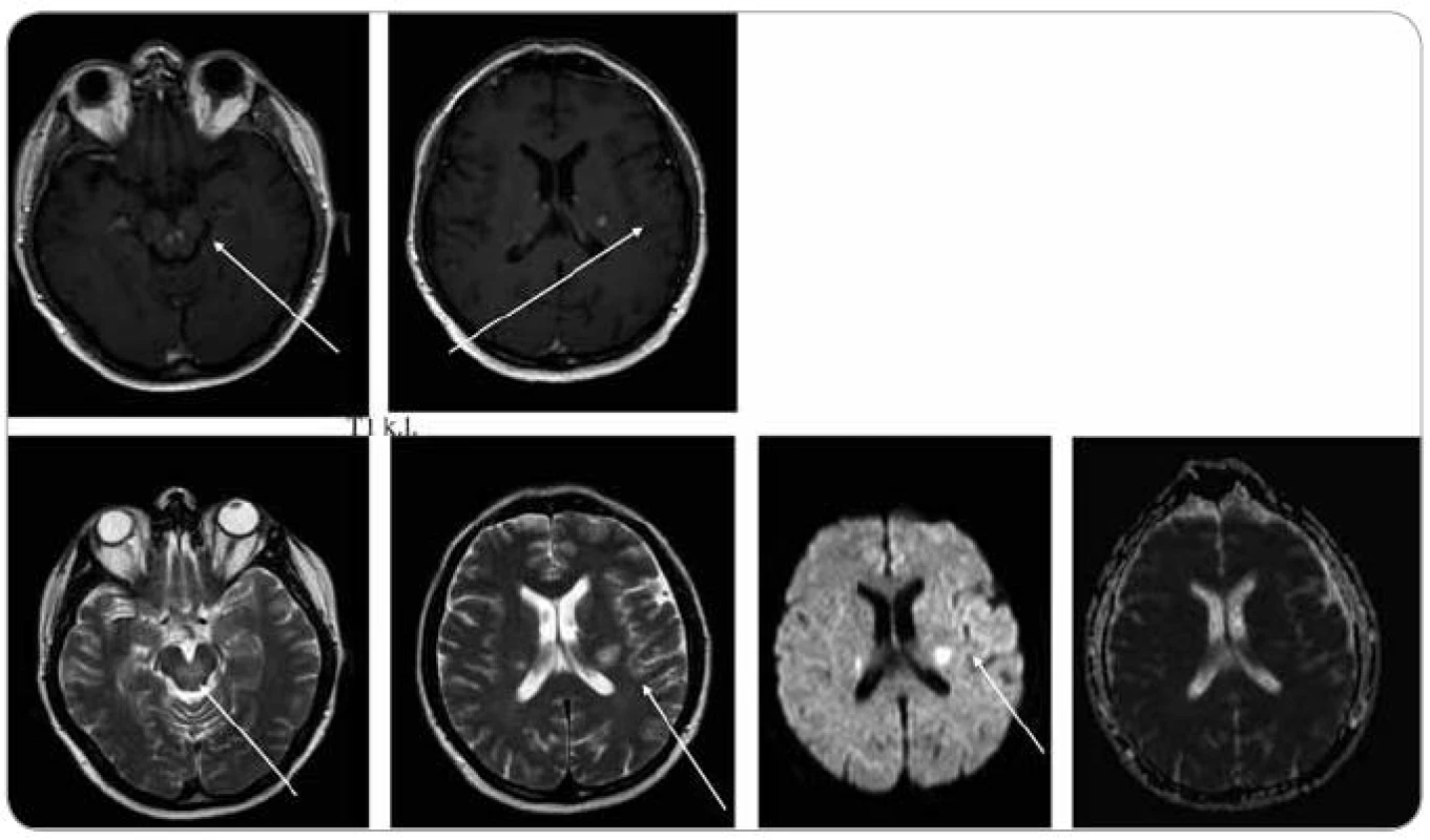 MR zobrazení mozku z 22. 1. 2009, tedy před léčbou. Na MR je viditelné postižení kmene, mozečku a bílé hmoty supratentoriálně, ložiska T1 hypo, T2 hyperintenzní, postkontrastně se sytící, restrikce difuze na DWI , bez korelace na ADC.