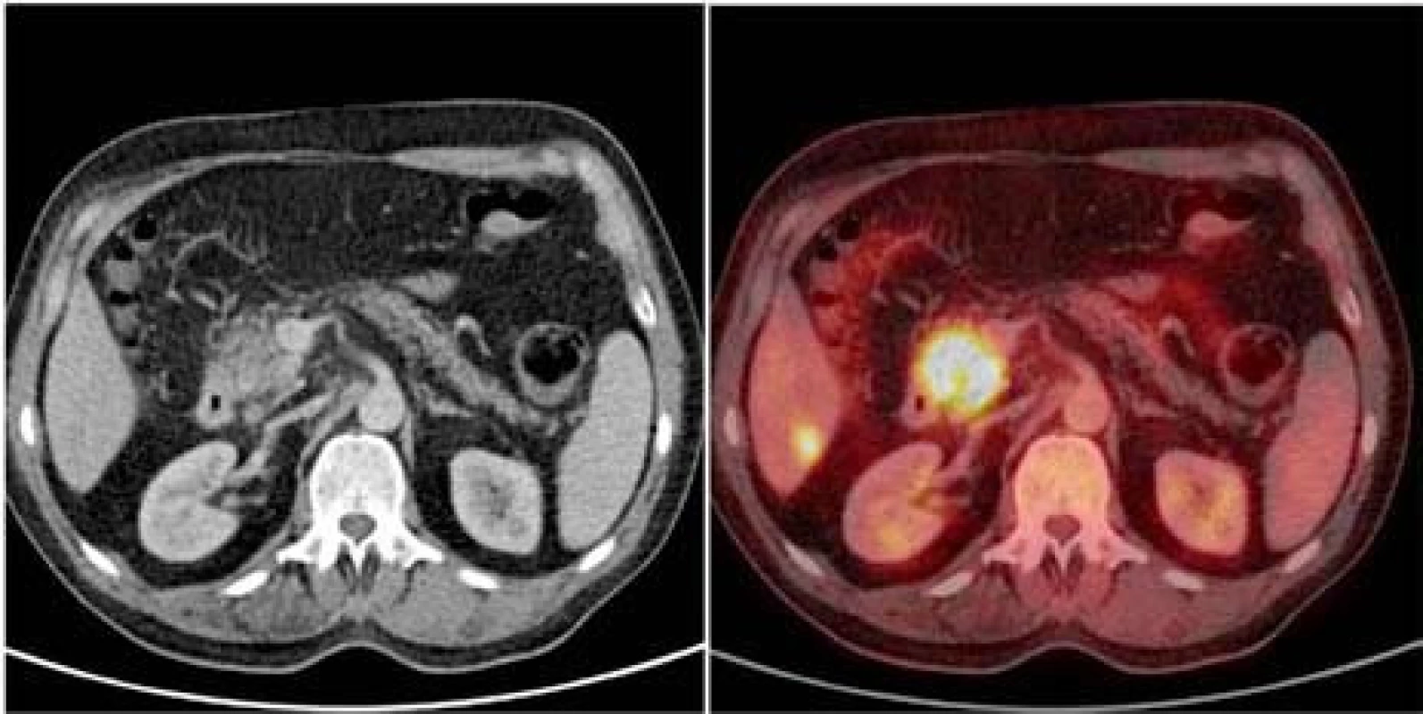 Axiální projekce hlavy pankreatu na CT vyšetření po podání kontrastní látky nitrožilně (vlevo), fúze téhož obrazu s &lt;sup&gt;18&lt;/sup&gt;FDG-PET vyšetřením (vpravo). Karcinom hlavy pankreatu o průměru více než 2 cm, drobná metastáza v 6. segmentu pravého laloku jater. Rozsah choroby nelze na CT spolehlivě rozlišit.
Fig. 1. Axial projection of head of pancreas on CT scan after IV administration of contrast agent (left), fusion of the same image with &lt;sup&gt;18&lt;/sup&gt;FDG-PET scan (right). Carcinoma of head of pancreas with the diameter of over 2 cm, small metastasis  in the sixth segment of the right hepatic lobe. The extent of the disease cannot be reliably distinguished on CT scan.
