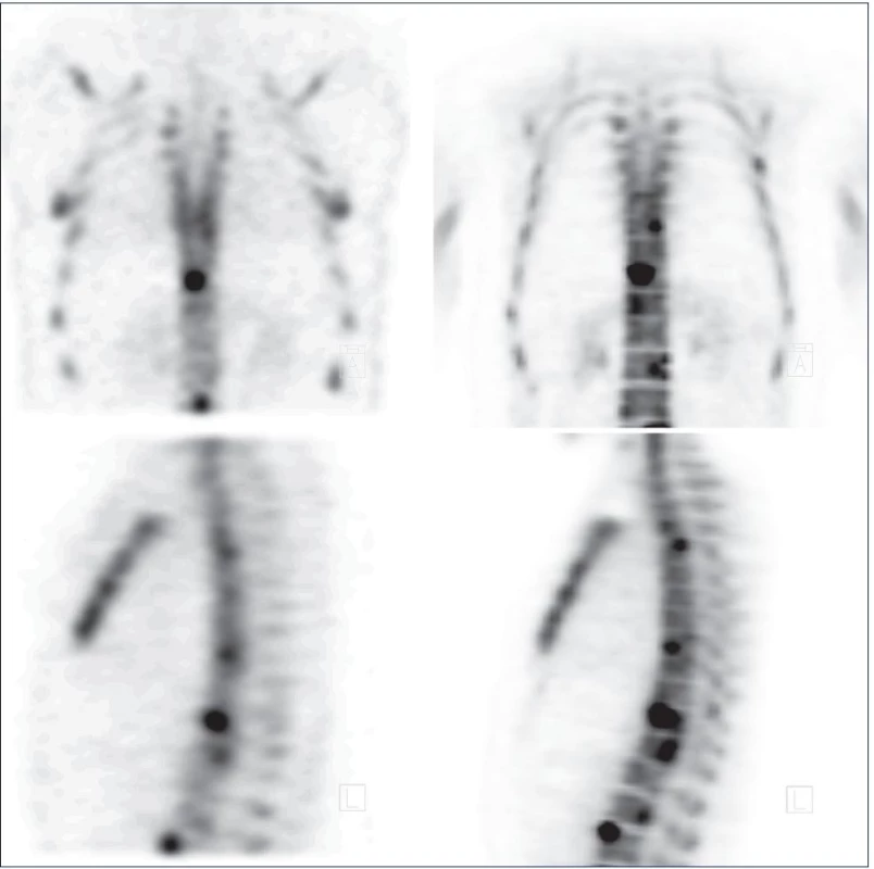 Porovnání nálezu téhož pacienta vyšetřeného v odstupu 10 dní kostní scintigrafi í SPECT pomocí difosfonátu (vlevo) a PET pomocí NaF (vpravo). Nahoře koronární řezy, dole sagitální řezy hrudní a části bederní páteře. S pomocí NaF-PET je dosaženo zřetelně vyšší kvality zobrazení rezultující v odhalení většího počtu kostních metastáz díky vyššímu kontrastu NaF a lepšímu prostorovému rozlišení PET.
Fig. 3. Comparison of bone scan (SPECT with labelled diphosphonate) on the left with NaF-PET on the right. Both investigations were undertaken within 10 days. Top: coronal slices; bottom sagittal slices of thoracic and part of lumbar spine. NaF-PET off ers image of substantially higher quality with the ability to discover more bony metastases thanks to higher contrast of NaF and thanks to better spatial resolution of PET.